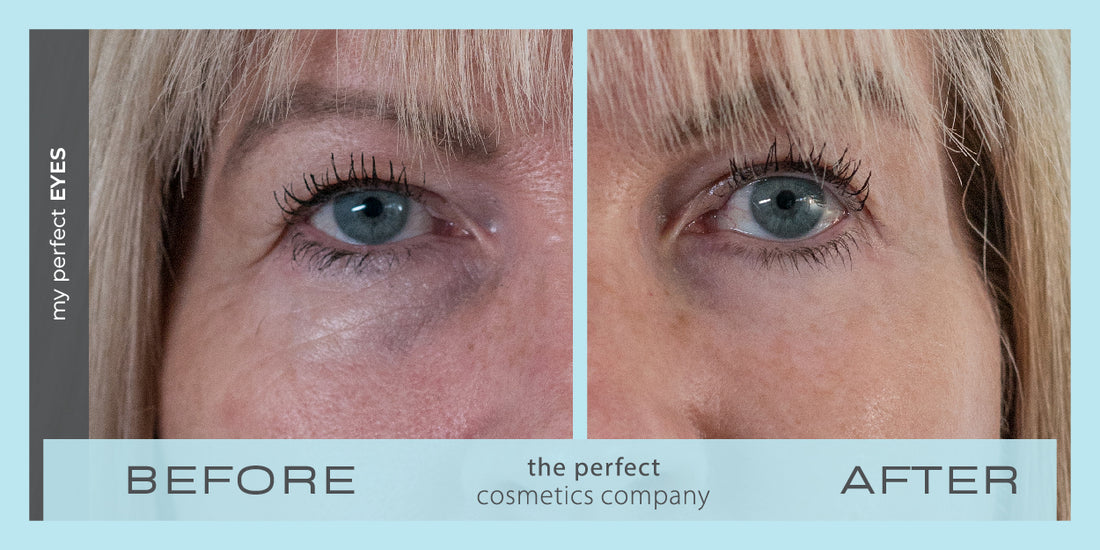 VISIA results